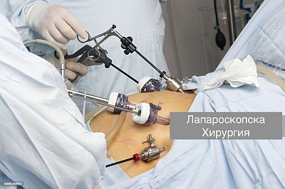 лапароскопска хирургия