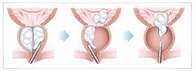 Holep Enucleation