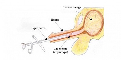 Уретротомия