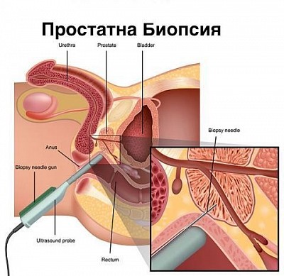 Трансректална биопсия на простатна жлеза