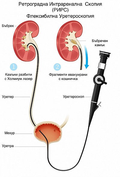 Уретерореноскопия РИРС